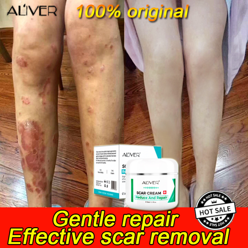 Original Aliver Scar Remover For Old Scar On Leg 50ml Peklat Remover Acne Surgical Stretch Marks 3681