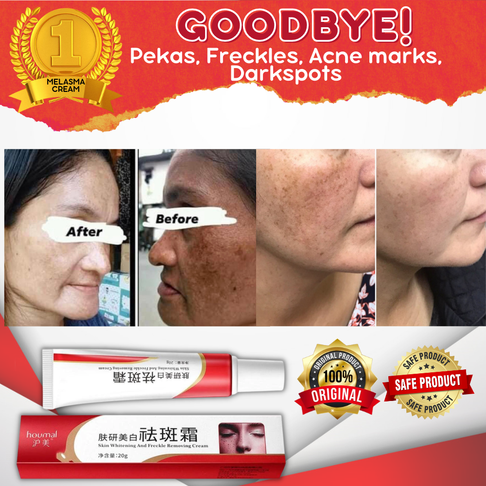 Lazada Philippines - 100% Effective and Original Whitening Freckle Cream Remover Original Pekas Remover Melasma Acne Dark Spot Melanin Pigmentation Moisturizing Skin Care 20g – FOR ALL SKIN TYPES Melasma Remover Oitment Melasma Cream Pantanggal ng Pekas Pantanggal ng Melasma