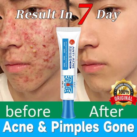 Pimple Eraser Acne Treatment Cream by 