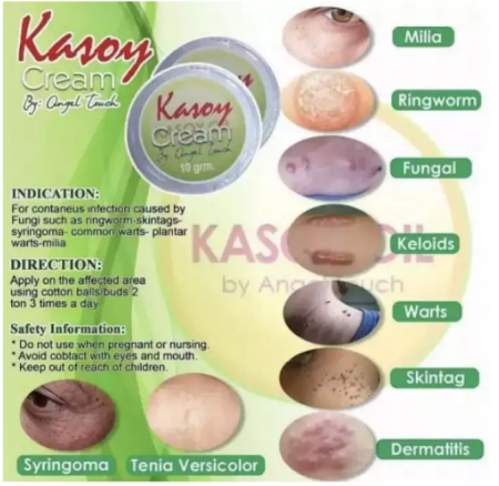 Kasoy Cream Warts Remover 10grams