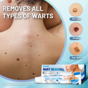"Original Watson Kasoy Oil Warts Remover for Skin Tags"