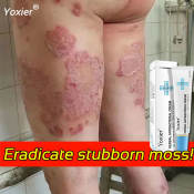 Yoxier Psoriasis Eczema Ointment - Immediate Relief for Skin Rashes