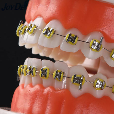 Sunkepo Dental Orthodontic Model with Metal Braces for Teaching