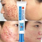 Acne Gone Cream - 100% Effective Acne Treatment by 