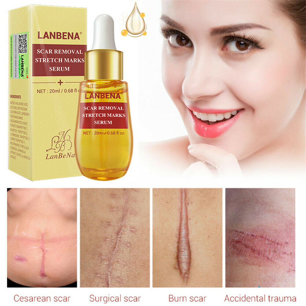 lanbena stretch mark