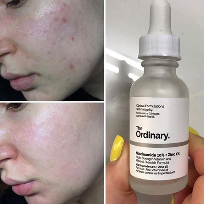 the ordinary niacinamide and zinc breakout