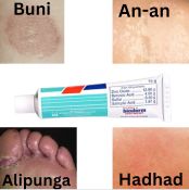 Anti-fungal Cream: Treats Various Skin Infections, 5g or 15g