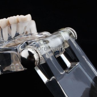 1PCS Dental Implant Disease Teeth Model With Restoration BridgeTooth Dentist For Medical Science Teaching NEW - Intl June 2018 - 4 1PCS Dental Implant Disease Teeth Model with Restoration BridgeTooth Dentist for Medical Science Teaching NEW - intl - 4