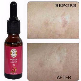 Bare Body Premium Rosehip Oil (15ml) Bundle Of 2 June 2018 - 4 Bare Body Premium Rosehip Oil (15ml) Bundle of 2 - 4
