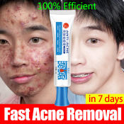 Pimple Remover Cream - Quick Acne Treatment by Original