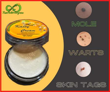 Kasoy Cream Warts, Moles & Skin Tags Remover - I Love Nature Organics