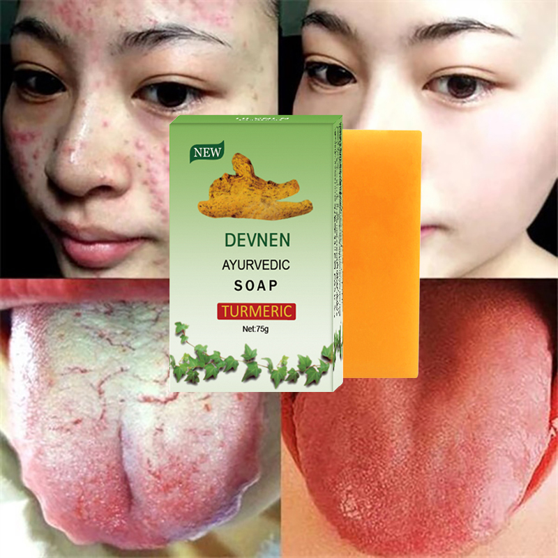 Legit Turmeric Soap: Acne, Pimple, Whitening, Anti-aging Treatment