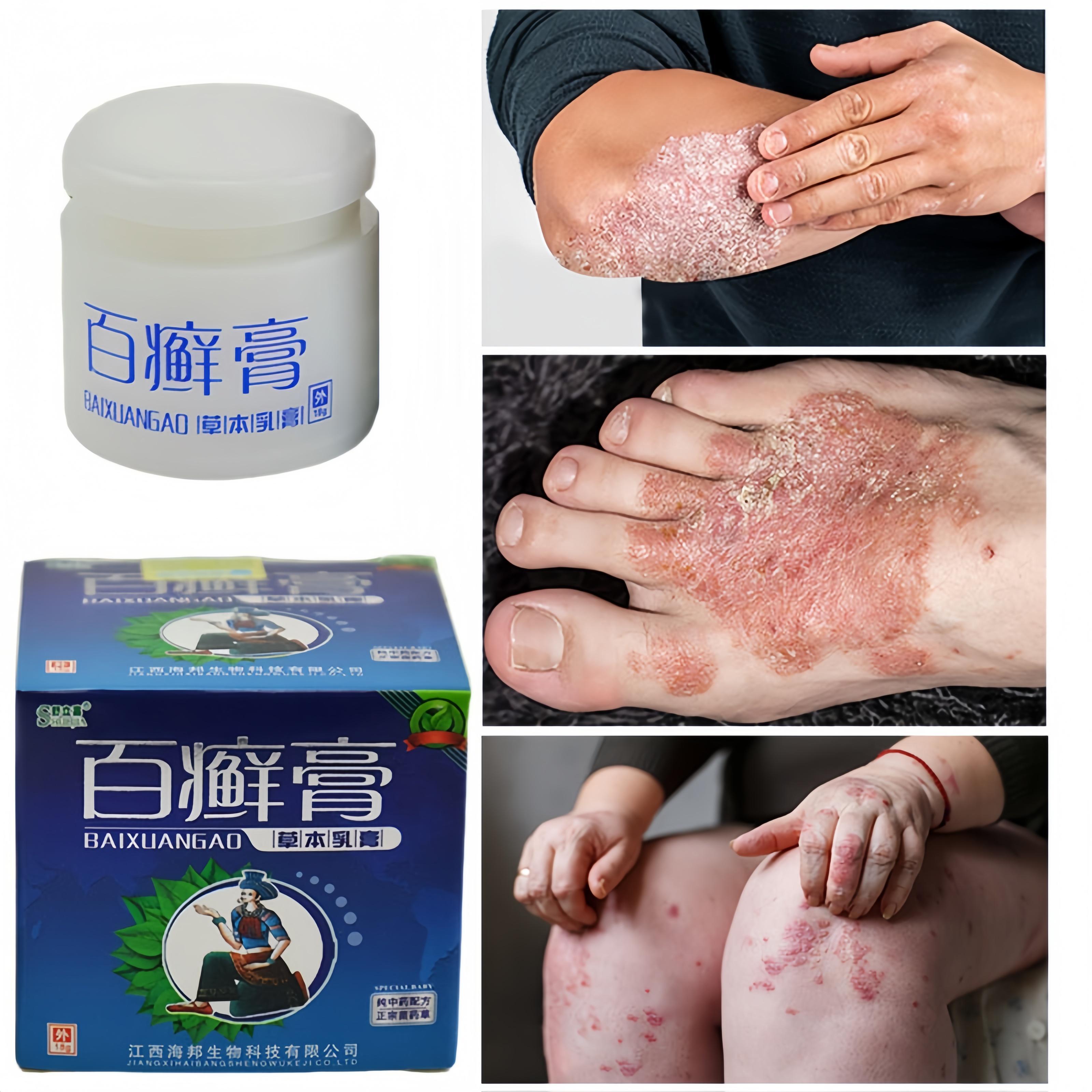 Bai Xuangao Herbal Skin Treatment Cream for Various Skin Conditions