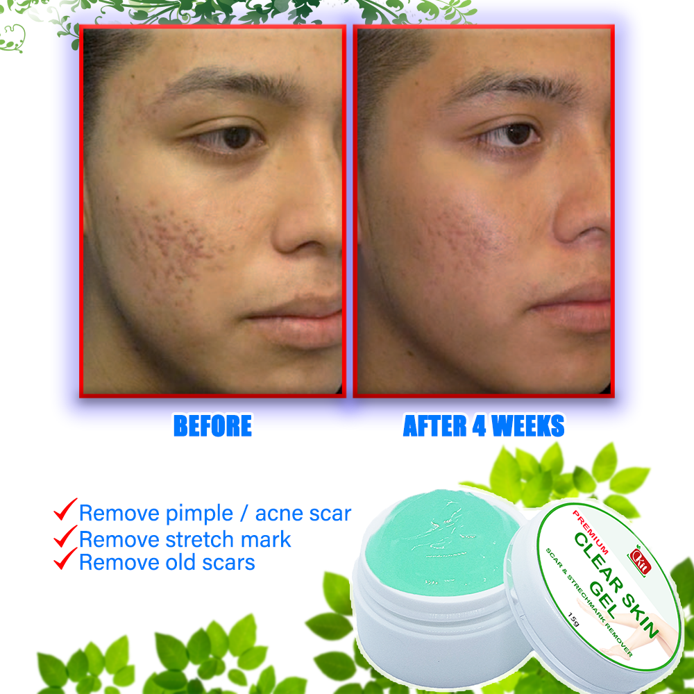 products to remove pimples