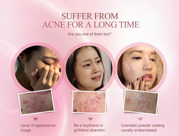 pair acne cream review