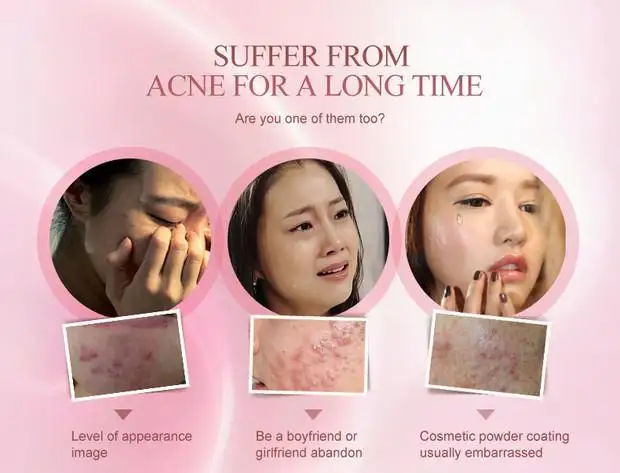 review pair acne cream