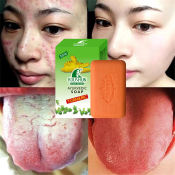 Legit Turmeric Soap: Acne, Pimple, Whitening, Anti-aging Treatment