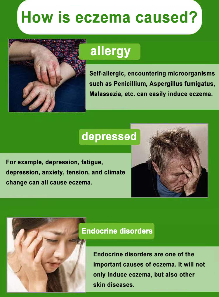 1pcs Genital Itch Relief Cream Scrotal Vulva Itching Tinea Cruris