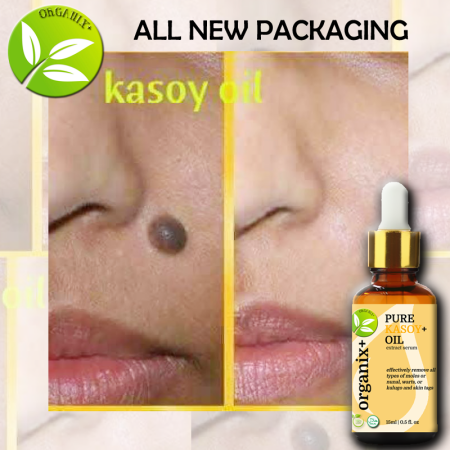 Organix Kasoy Oil: Warts, Tags, and Skin Growth Remover