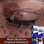 Painless Warts Remover Cream - Effective Skin Tag & Wart Removal