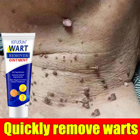 Original Warts Remover Cream by Warts Magic