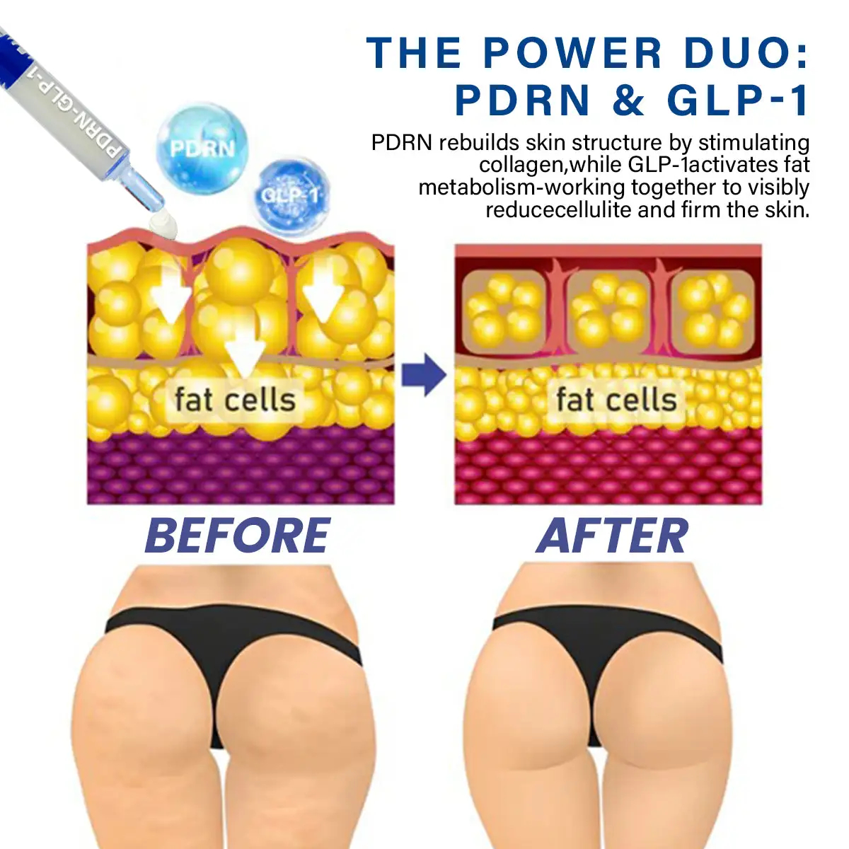 glp 1 and cellulite Does GLP-1 Help With Cellulite? What to Expect PDRN-GLP-1 Weight Loss REEDLE SHOT