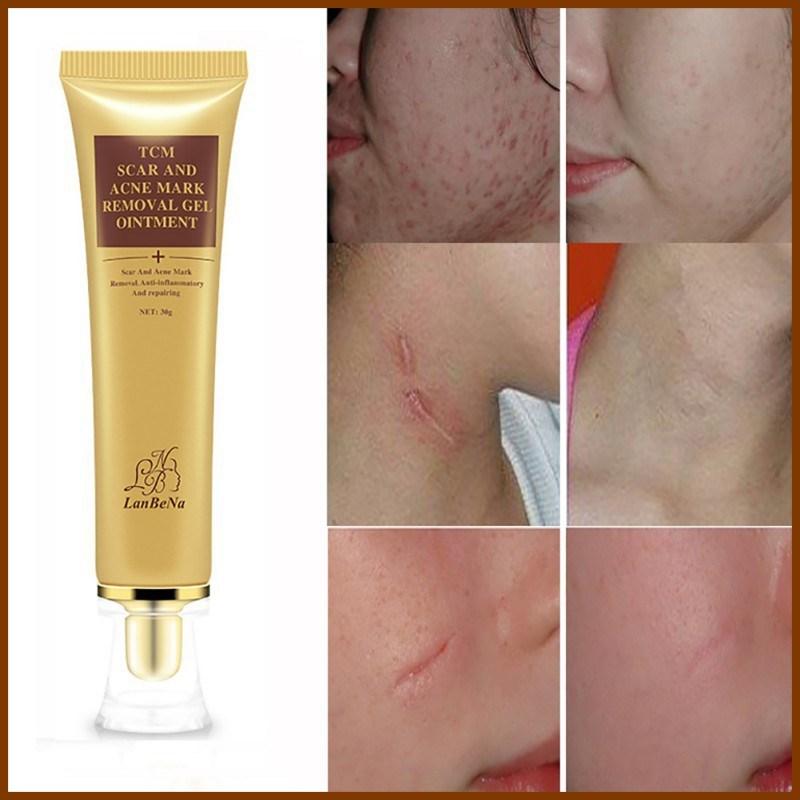 lan be na tcm scar and acne mark removal gel ointment
