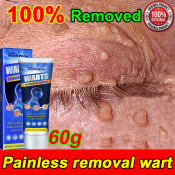 60g Warts Remover Cream - 100% Effective & Painless