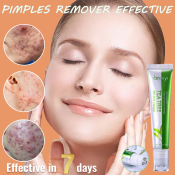 Acne Scar Gel - Effective Pimple Remover for Men