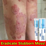 Herbal Psoriasis Cream for Fast, Effective Eczema Treatment 