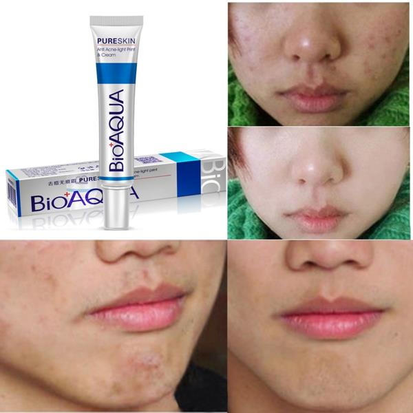 bioaqua acne review